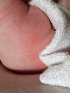 Diaper rash; how does it come about and what can you do about it? (Note: with photos)